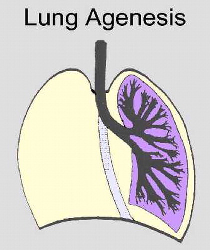 4. Bất sản phổi (Pulmonary Agenesis) và thiểu sản phổi (Pulmonary Hypoplasia)