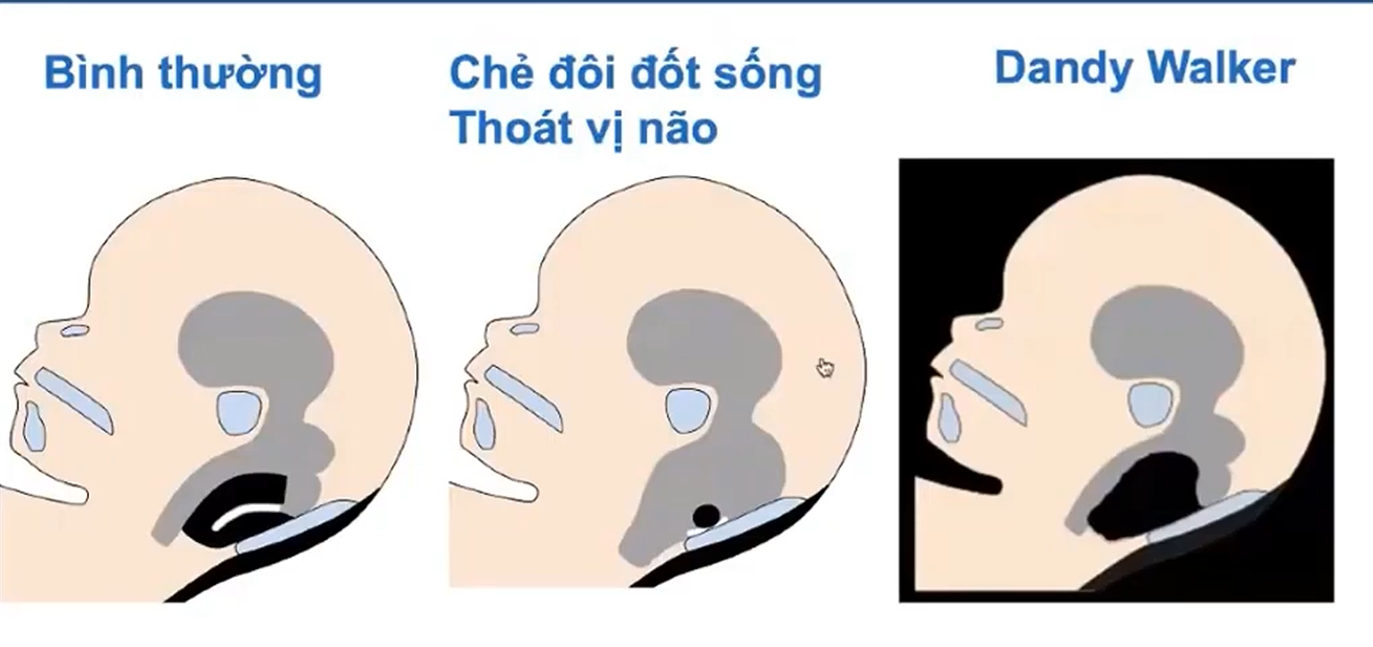7. Bất thường hố sau