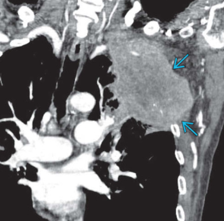 Di căn thành ngực (Chest Wall Metastases)