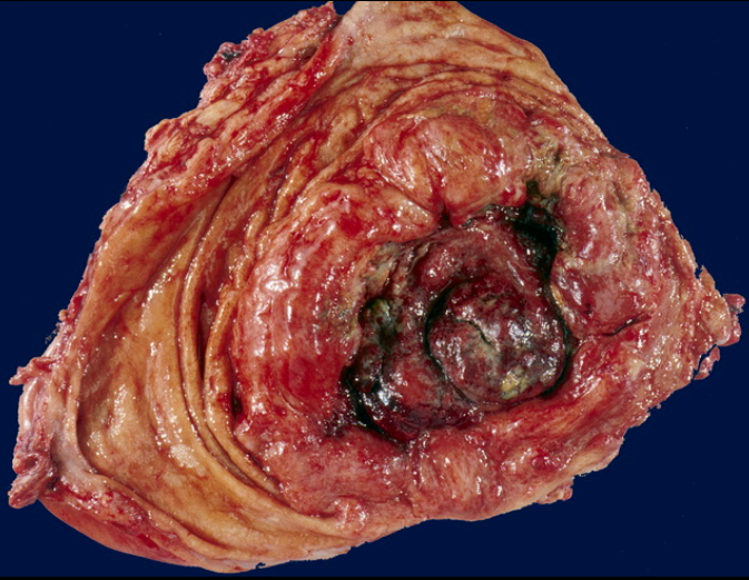 Di căn dạ dày và U lympho dạ dày (Gastric Metastases and Lymphoma)