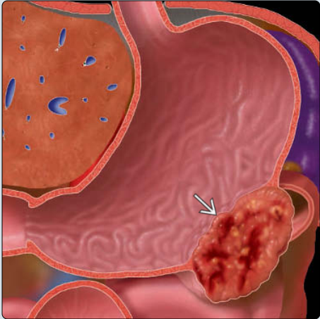 U mô đệm đường tiêu hóa (Gastrointestinal stromal tumor - GIST)