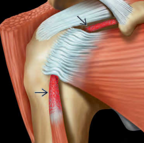 Viêm gân cơ nhị đầu (Biceps Tendinopathy, Shoulder)