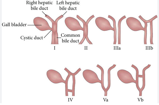 Đường mật đôi (Bile Duct Duplication) 