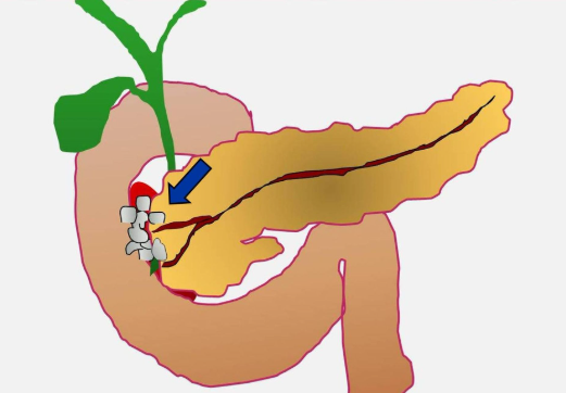 Viêm tụy cạnh tá tràng (Paraduodenal Pancreatitis) 