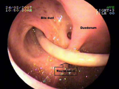 Bệnh giun đũa đường mật (Biliary ascariasis)