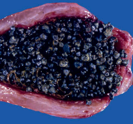 Bùn túi mật (Gallbladder sludge)