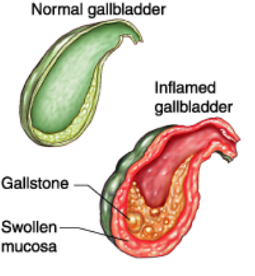 Viêm túi mật cấp tính không sỏi (Acute acalculous cholecystitis)