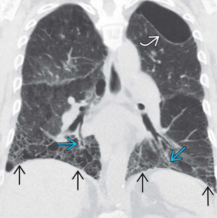 Hội chứng xơ hóa phổi và khí phế thũng kết hợp (Combined Pulmonary Fibrosis and Emphysema - CPFE)