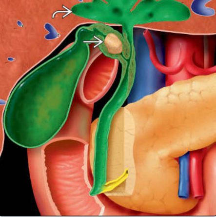 Hội chứng Mirizzi (Mirizzi Syndrome)