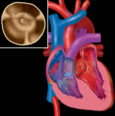 Hẹp động mạch phổi bẩm sinh (Congenital Pulmonary Stenosis)