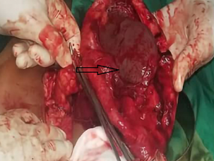 Nhiễm trùng nang sán chó ở lách (Splenic hydatid infection)