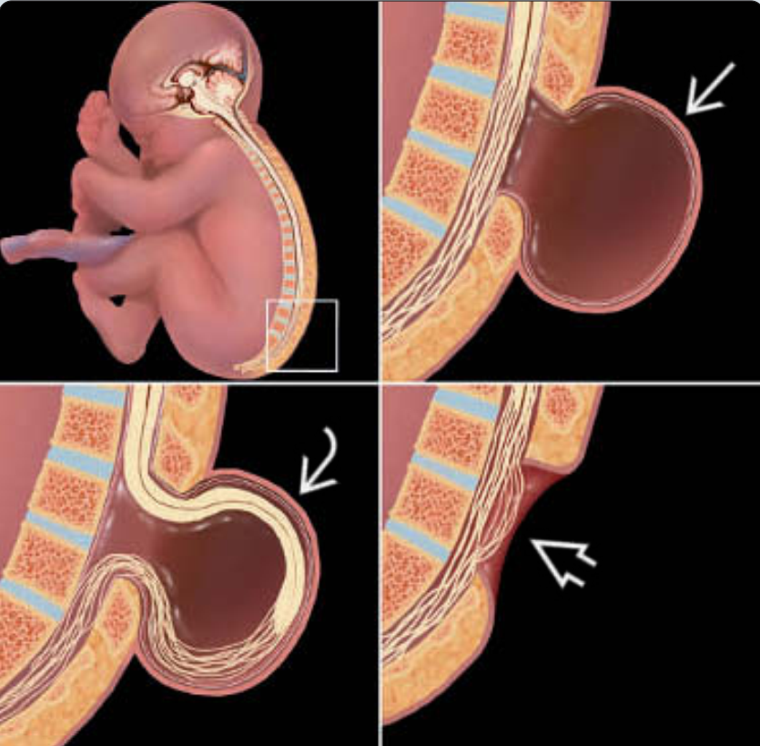 Chẻ đôi đốt sống (Spina Bifida)