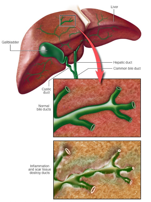 Viêm đường mật xơ cứng nguyên phát (Primary Sclerosing Cholangitis - PSC) 