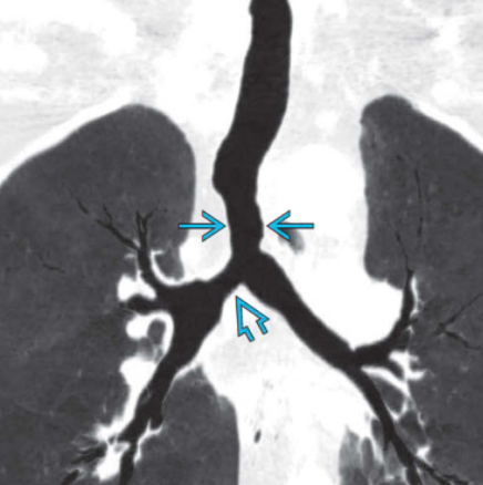 Viêm đa sụn tái phát (Relapsing Polychondritis)