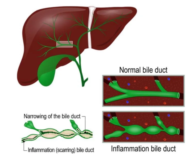 Bệnh Caroli và Hội chứng Caroli (Caroli disease and Caroli syndrome)