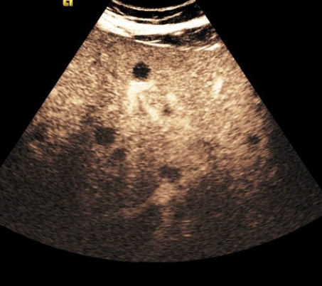 Nhiễm Candida gan lách (Hepatosplenic candidiasis)