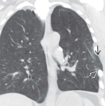 Thoát vị phổi (Lung Herniation)