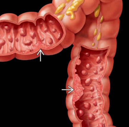 Hội chứng đa polyp tuyến gia đình (Familial Adenomatous Polyposis)