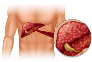 Áp xe mủ túi mật (Gallbladder empyema)