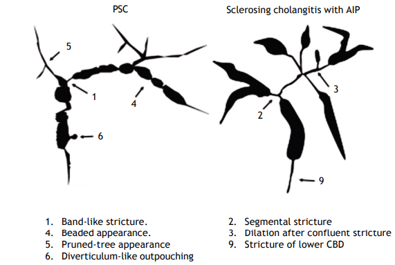 Viêm đường mật xơ cứng liên quan đến IgG4 (IgG4-related sclerosing cholangitis - IgG4-RSC)