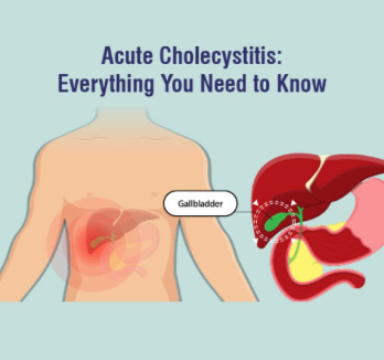 Viêm túi mật cấp không do sỏi (Acute Acalculous Cholecystitis - AC)