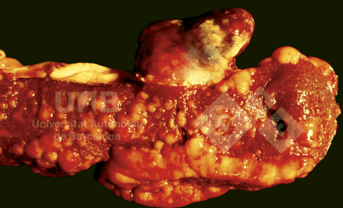 U lympho lách (Splenic lymphoma)