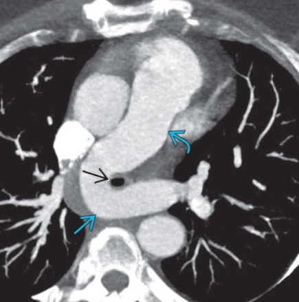 Động mạch phổi trái lạc chỗ (Aberrant left pulmonary artery)/Vòng động mạch phổi (Pulmonary artery sling - PAS)