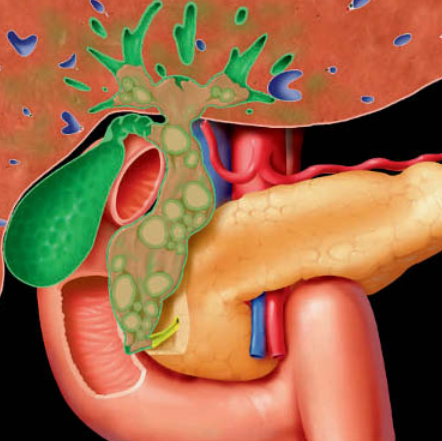 Viêm đường mật sinh mủ tái phát (Recurrent pyogenic cholangiohepatitis)