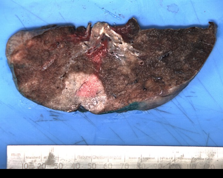 Ung thư biểu mô tuyến phổi (Adenocarcinoma of the lung)