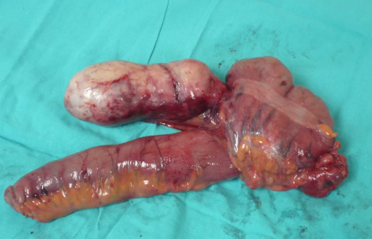 U thần kinh nội tiết ruột thừa  (Appendiceal neuroendocrine tumor)