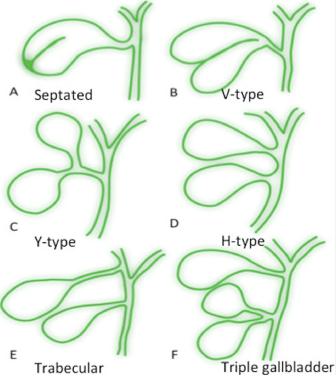 Bất sản túi mật (Gallbladder Agenesis)