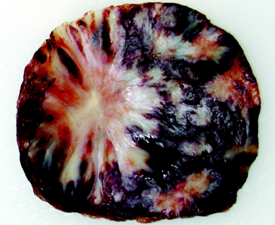 Biến đổi nốt mạch máu xơ hóa (SANT) của lách (Sclerosing angiomatoid nodular transformation of the spleen)