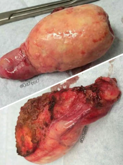 Túi mật sứ (Porcelain Gallbladder)