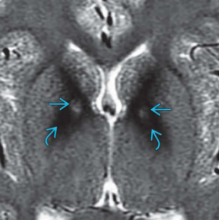 Thoái hóa thần kinh với tích tụ sắt trong não (Neurodegeneration with Brain Iron Accumulation - NBIA)