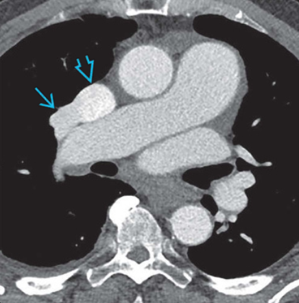 Thông liên nhĩ (Atrial Septal Defect - ASD)