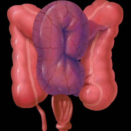 Xoắn đại tràng sigma (Sigmoid volvulus)