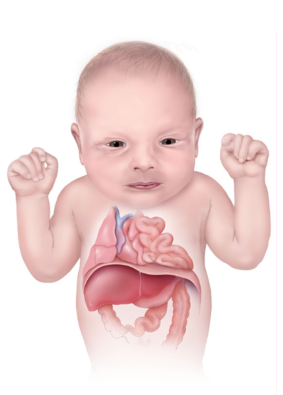 3. Thoát vị hoành bẩm sinh (Congenital Diaphragmatic Hernia- CDH)