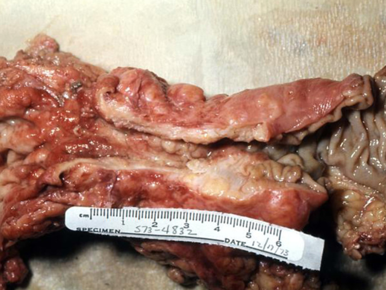 Ung thư đại trực tràng (Colorectal cancer)