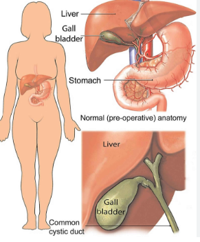 Viêm túi mật sinh hơi (Emphysematous Cholecystitis) 