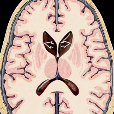 Huntington Disease - HD