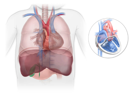 Hội chứng không lách (Asplenia syndrome)