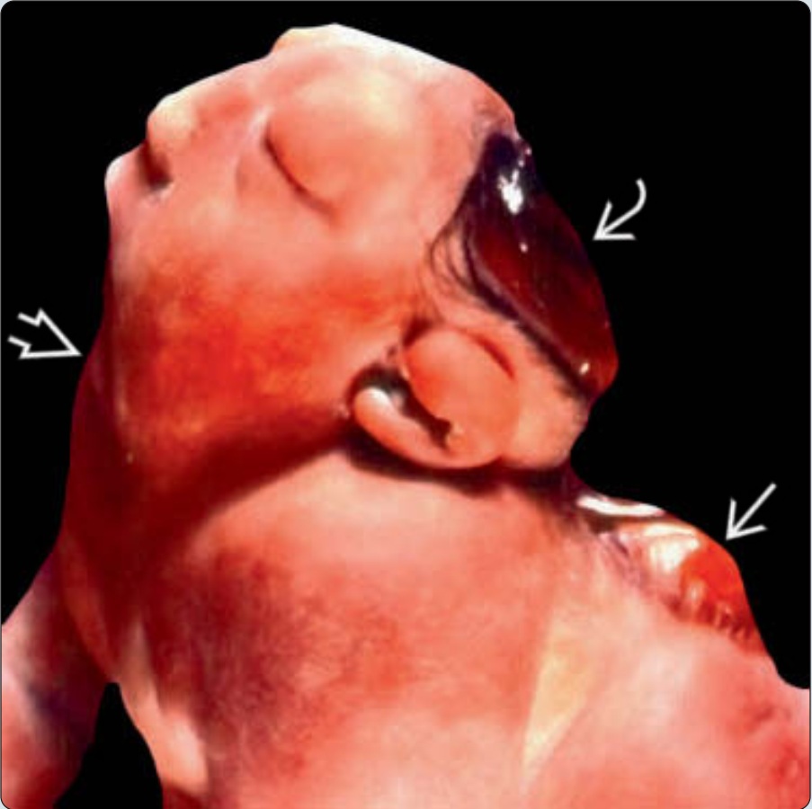 Dị tật dính liền đầu- cổ (Iniencephaly)