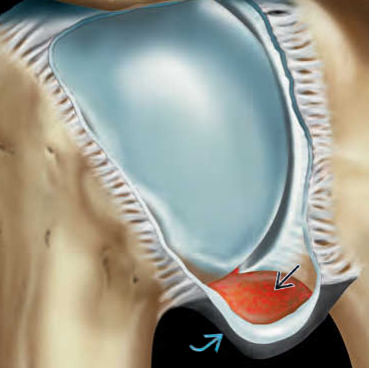 Viêm dính bao khớp vai (Adhesive capsulitis of the shoulder)
