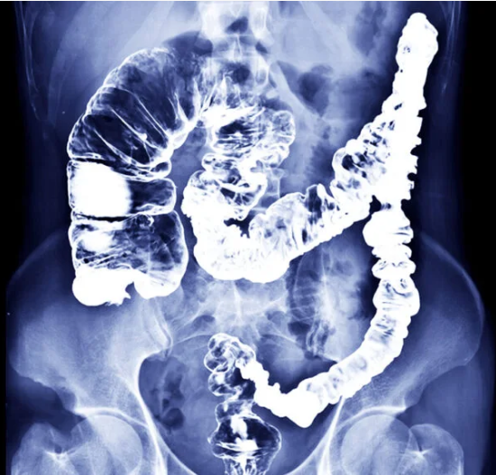 Viêm đại tràng do phân cứng (Stercoral colitis)