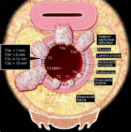 Ung thư trực tràng (Rectal cancer)